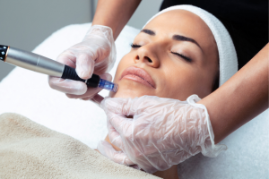 microneedling st albert skin treatment